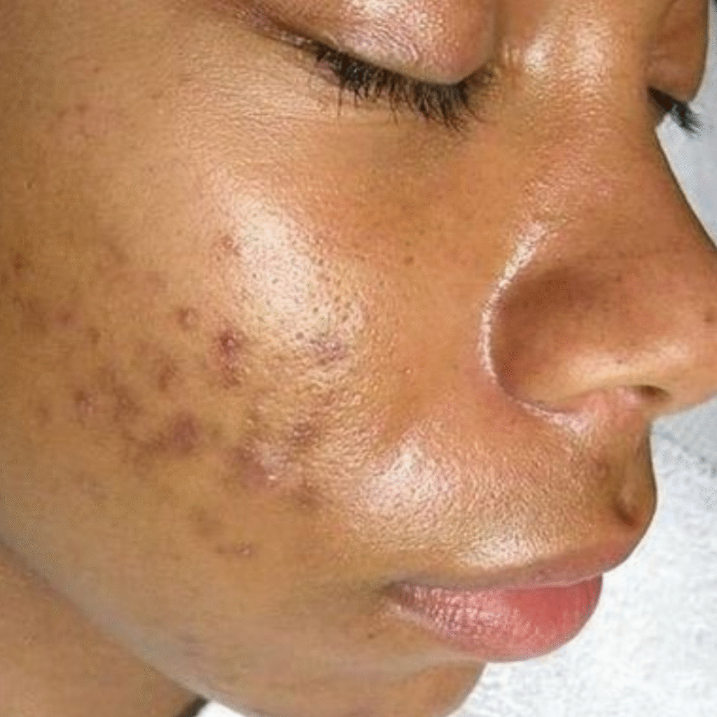 Before using Kojic Acid soap